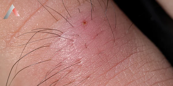 Kıl Dönmesi Nedir?